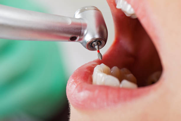 Best Emergency Root Canal Treatment in Huguley, AL